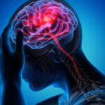 La fisioterapia puede ayudar con las migrañas