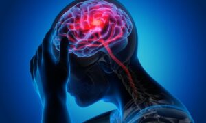 La fisioterapia puede ayudar con las migrañas